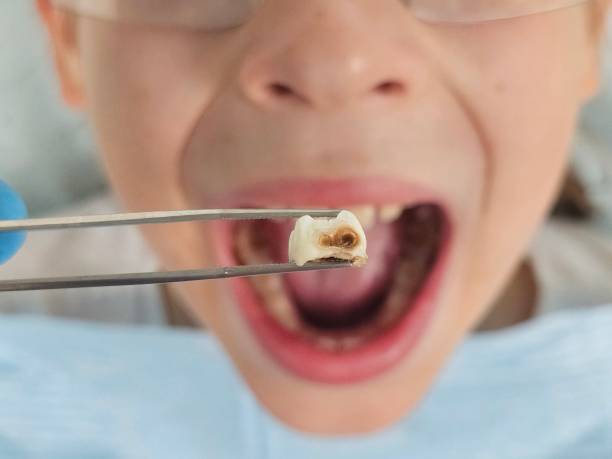 Best Emergency Treatment for Dental Infections or Abscesses in Stedman, NC